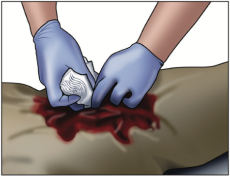 What's the Difference Between QuikClot Combat Hemostatic Gauze and CELOX RAPID Hemostatic Gauze?